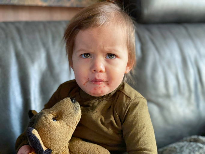 Hand, Foot, and Mouth Disease (HFMD): Symptoms, Care, and Relief